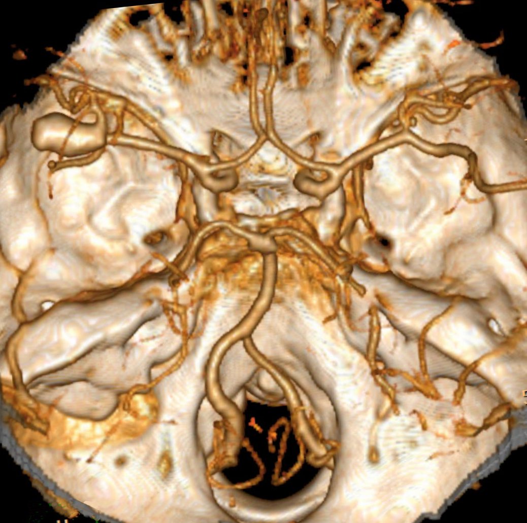 Aneurisma sacciforme dell'arteria cerebrale media