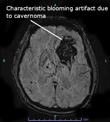 Cavernoma cerebrale — artefatto da blooming su sequenza DWI