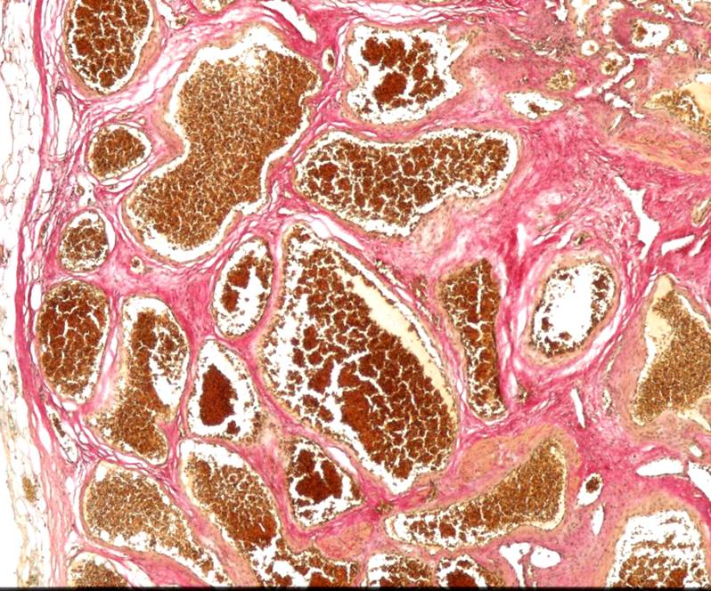 Cavernoma — quadro istologico