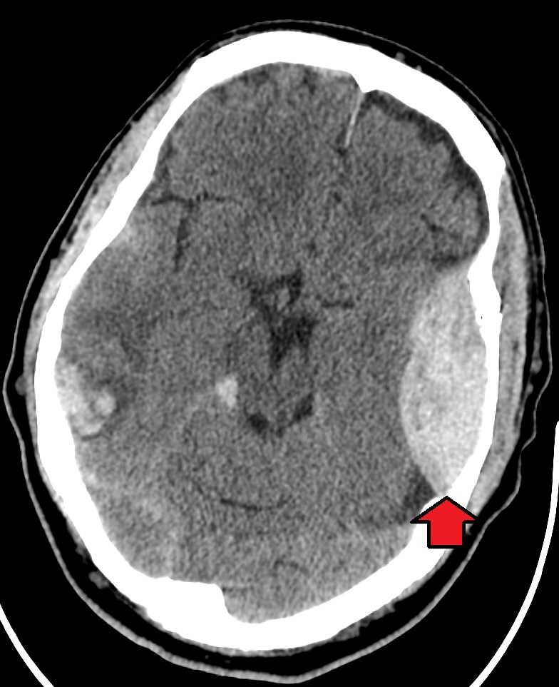 Ematoma epidurale su TC encefalo