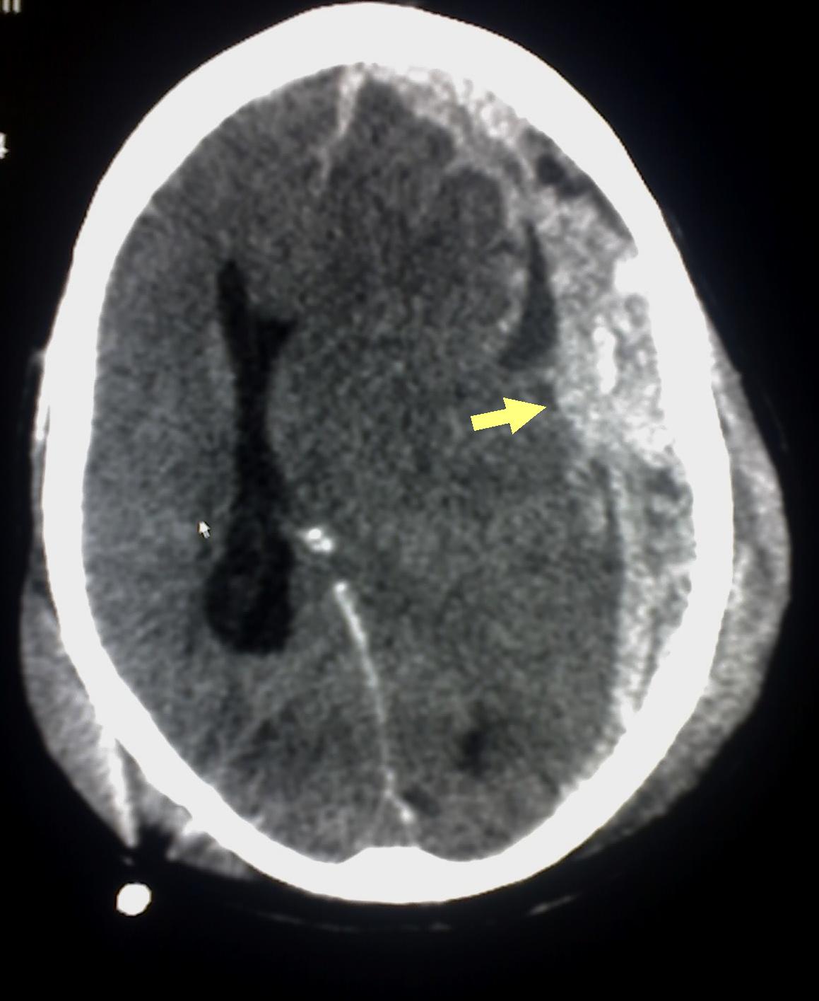 Ematoma subdurale acuto su TC encefalo