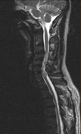 Ependimoma intramidollare su RM
