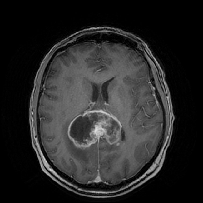 Glioblastoma a farfalla bilaterale che attraversa il corpo calloso, RM con contrasto