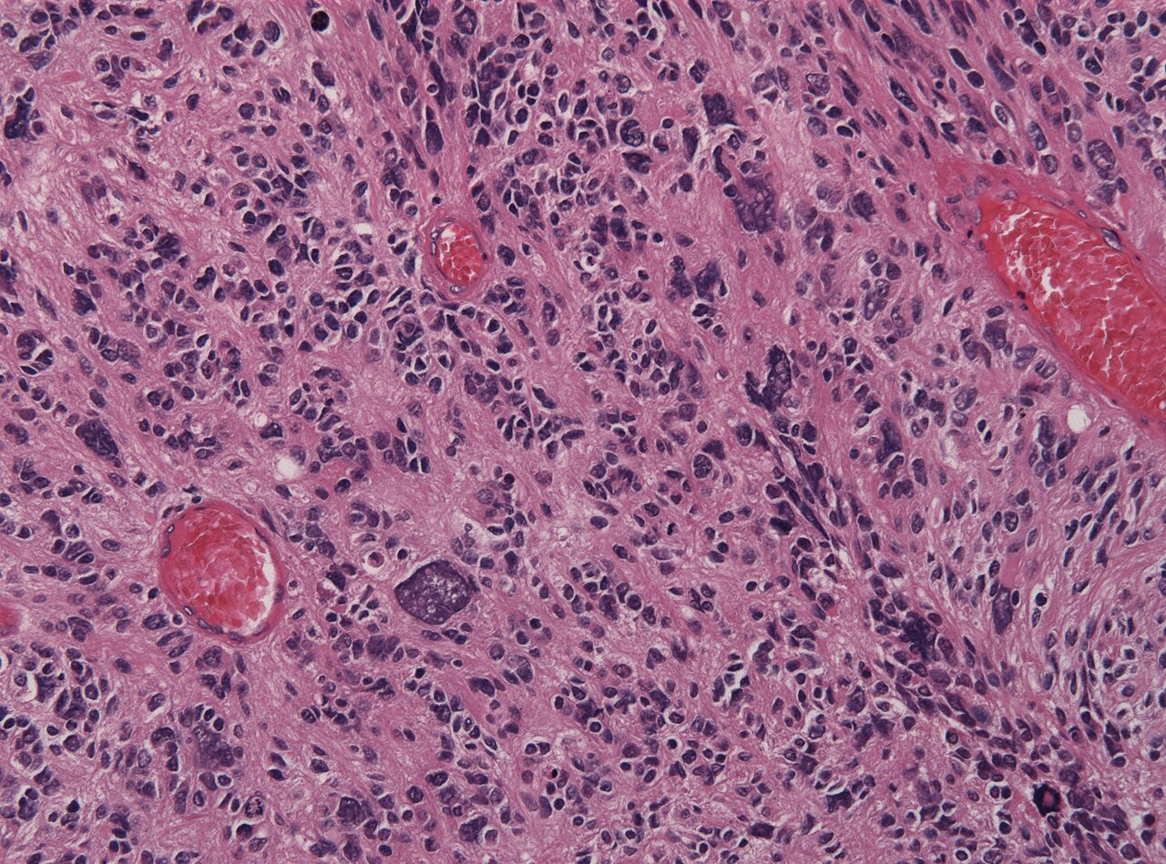 Glioblastoma — istologia pleomorfismo H&E