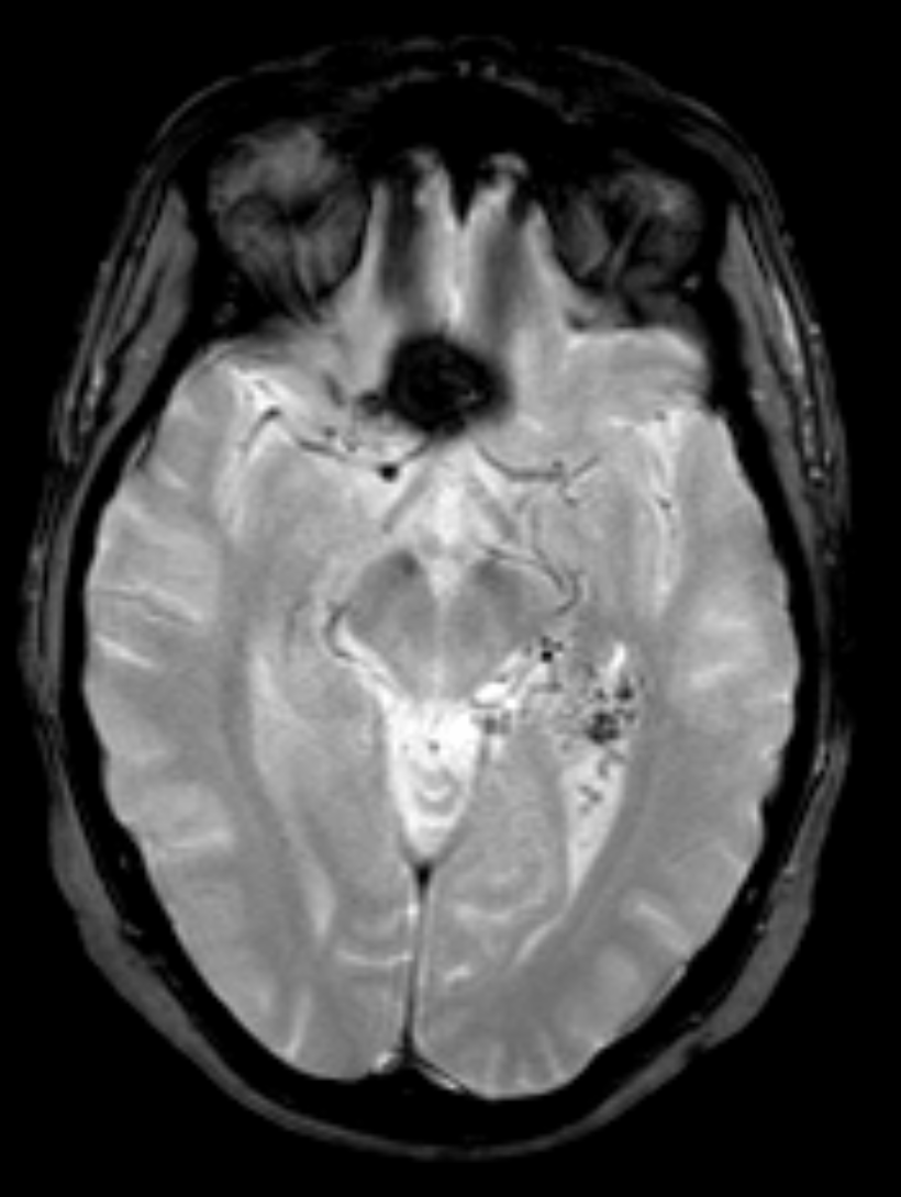 RM encefalo T2* assiale: malformazione artero-venosa cerebrale con nidus di vasi serpiginosi