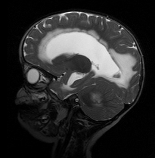 Medulloblastoma su RM sagittale T2