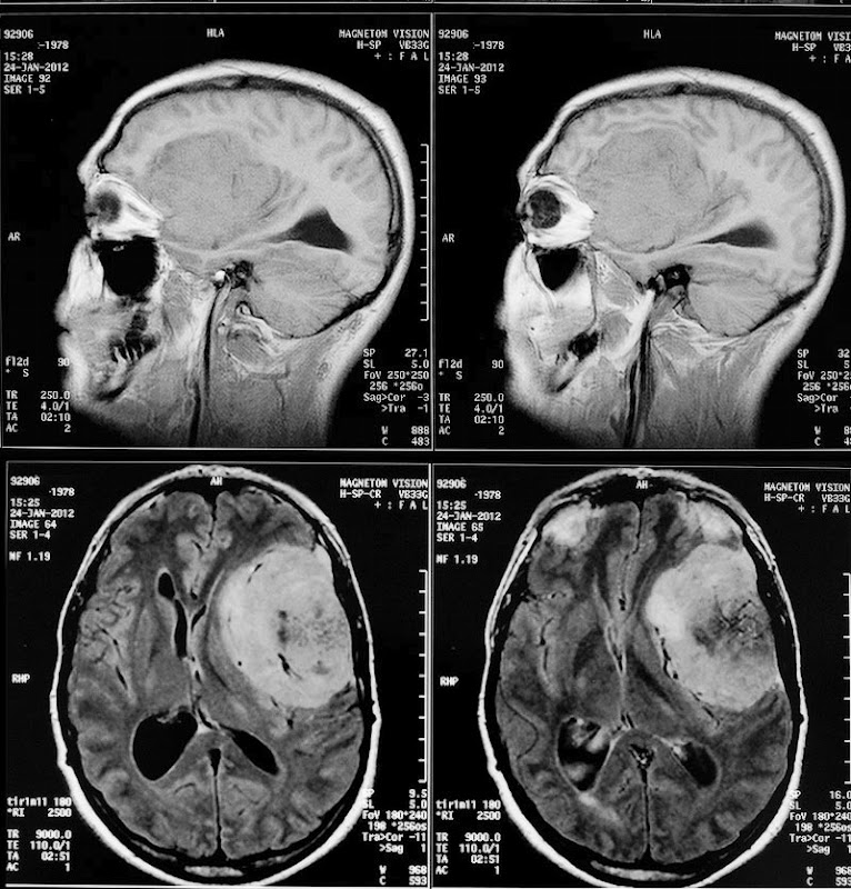 Meningioma su RM encefalo post-contrasto