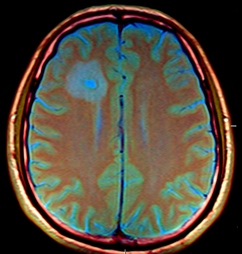 Metastasi cerebrali su RM multiparametrica