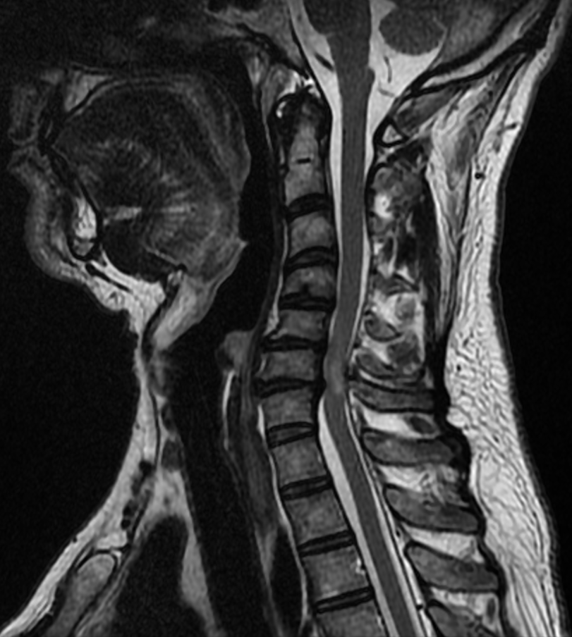 Mielopatia cervicale C6-C7 — RM sagittale T2