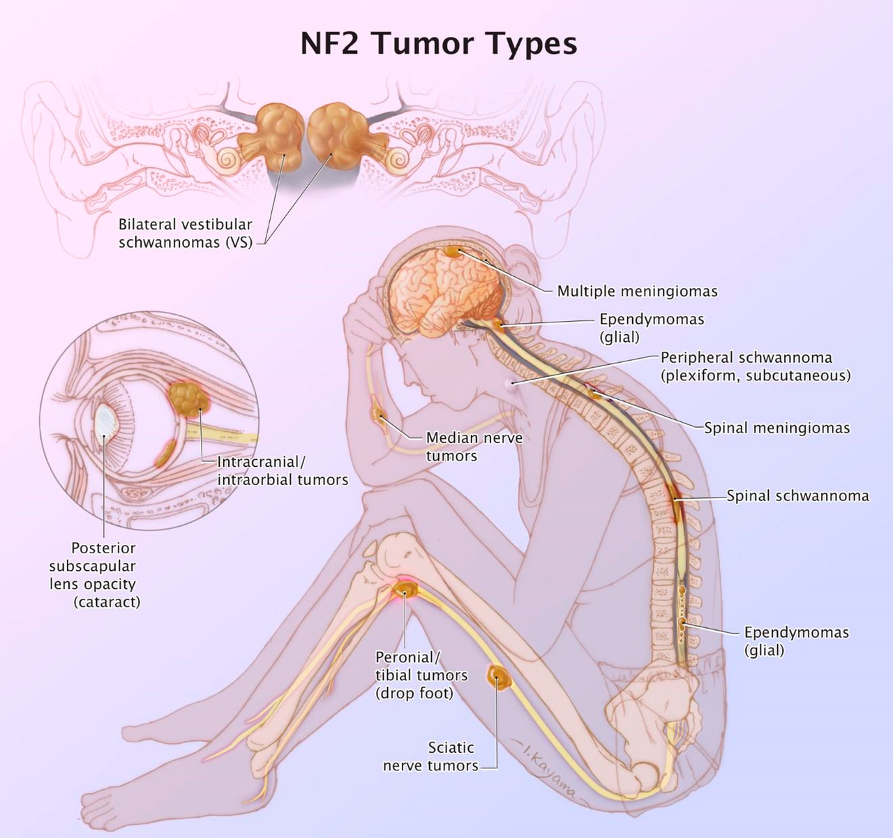 NF2 — distribuzione tumorale tipica