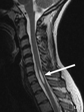 Siringomielia su RM cervicale T2