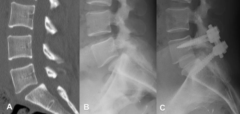 Spondilolistesi lombare — Rx e TC pre/post-operatorie