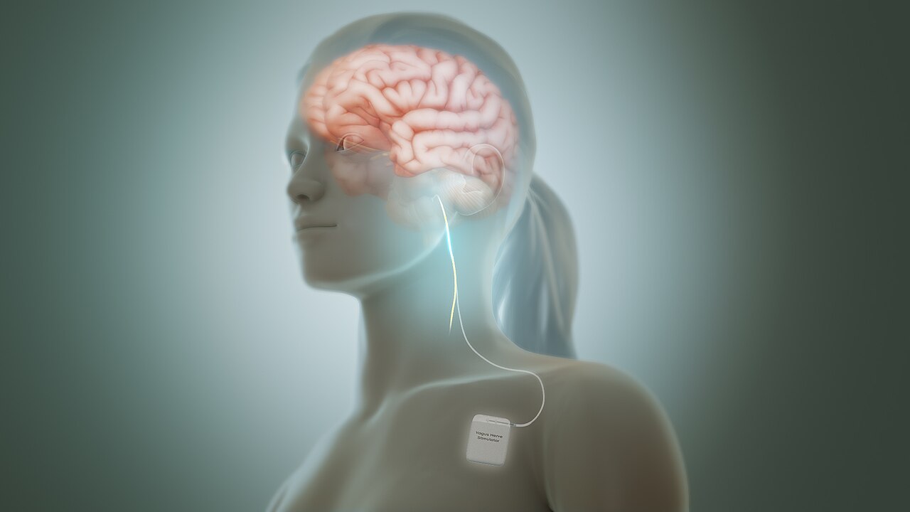 Sistema di stimolazione del nervo vago (VNS) — schema